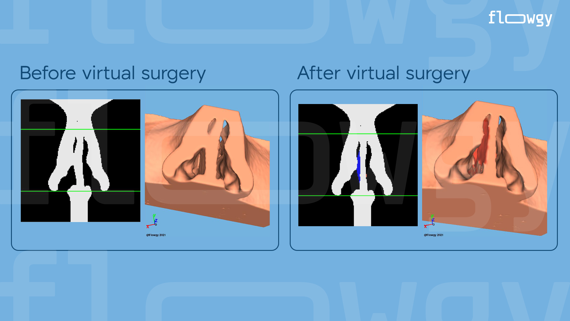 Comparison between a nasal cavity without virtual surgery and one operated with Flowgy.