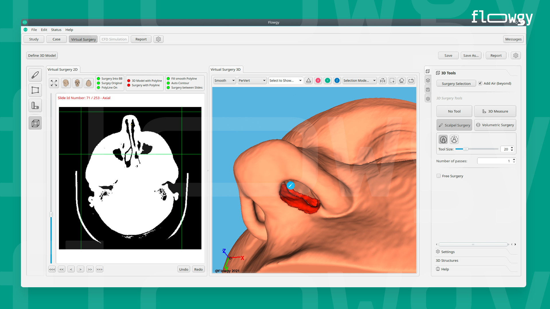 An example of a virtual surgery made with Flowgy Innovation.